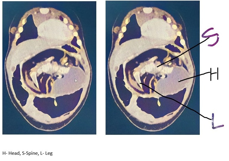 fetus in 5-months-old girl