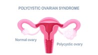 Tips to cure PCOD