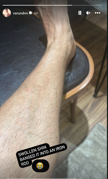 varun dhawan injury